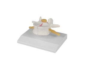 Wervel Model met Osteoporose, 2 x ware grootte