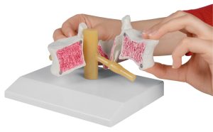 Wervel Model met Osteoporose, 2 x ware grootte