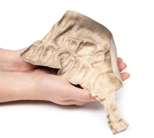 Ziekte van Hirschsprung, 3D Print